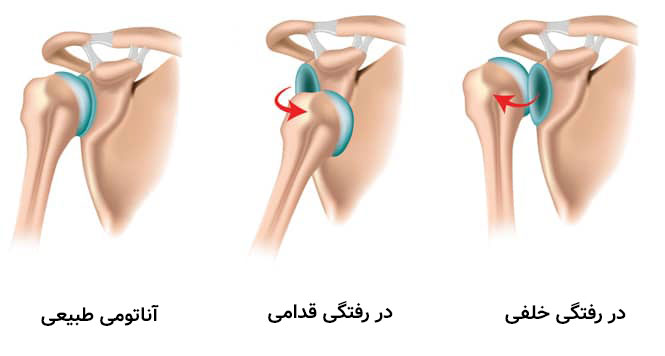 در رفتگی مفصل شانه